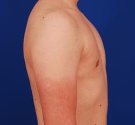 Gynecomastia Surgery Before & After Image