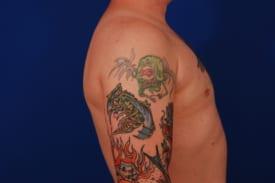 Gynecomastia Surgery Before & After Image