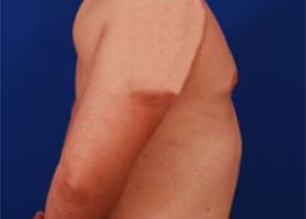 Gynecomastia Surgery Before & After Image