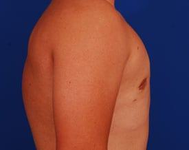 Gynecomastia Surgery Before & After Image