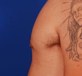 Gynecomastia Surgery Before & After Image