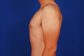 Gynecomastia Surgery Before & After Image