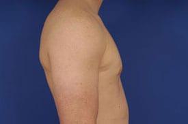 Gynecomastia Surgery Before & After Image