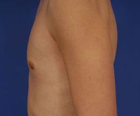 Gynecomastia Surgery Before & After Image