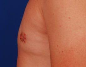 Gynecomastia Surgery Before & After Image
