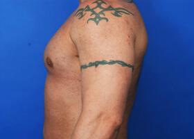 Revision Gynecomastia Surgery Before & After Image