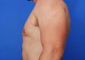 Revision Gynecomastia Surgery Before & After Image