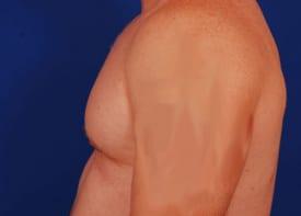 Revision Gynecomastia Surgery Before & After Image