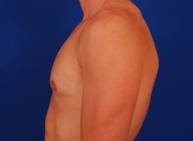 Revision Gynecomastia Surgery Before & After Image
