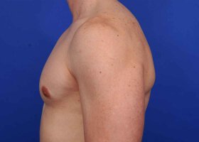 Austin Gynecomastia Surgery patient After