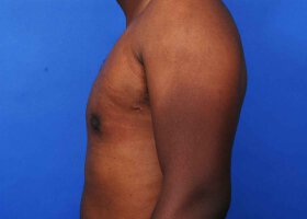 Austin Gynecomastia Surgery patient After