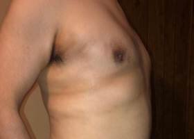 After Austin Gynecomastia Surgery patient