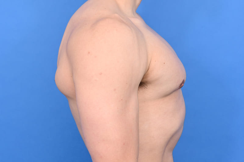 Gynecomastia Surgery Before & After Image