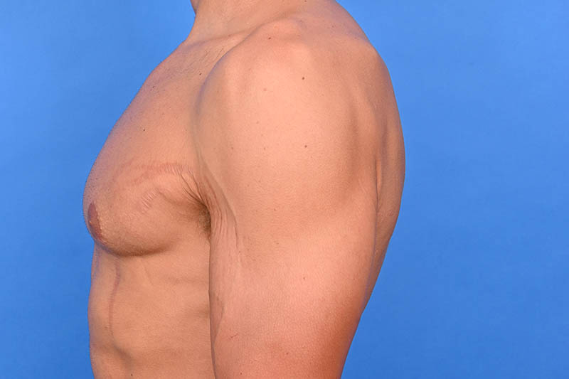 Gynecomastia Surgery Before & After Image