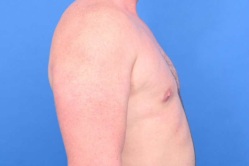 Gynecomastia Surgery Before & After Image