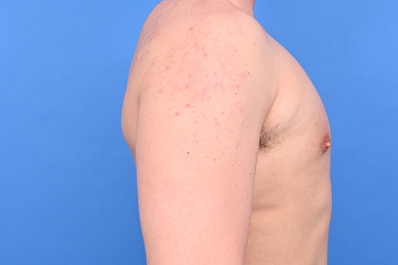 Gynecomastia Surgery Before & After Image