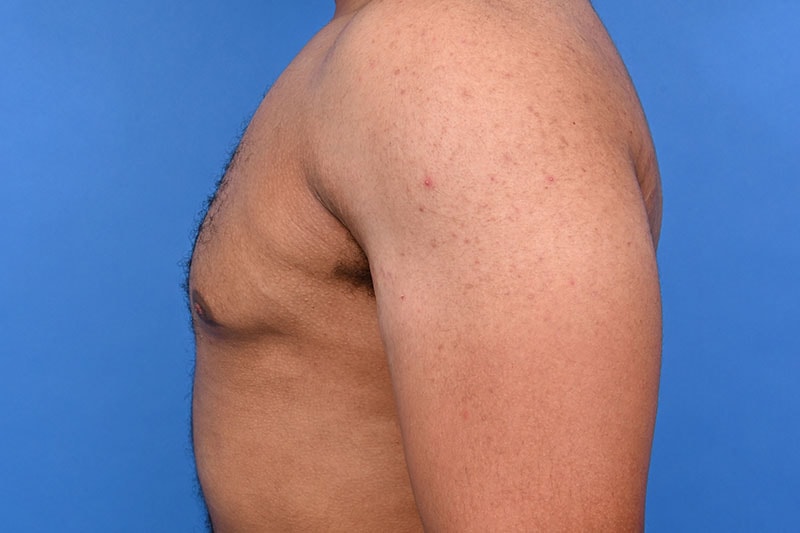 Gynecomastia Surgery Before & After Image