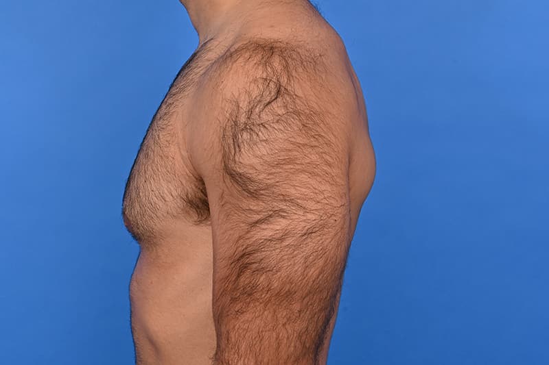 Gynecomastia Surgery Before & After Image