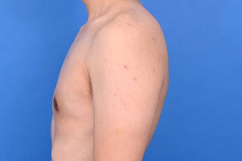 Gynecomastia Surgery Before & After Image