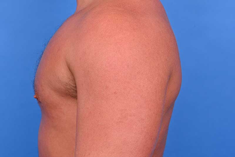 Gynecomastia Surgery Before & After Image