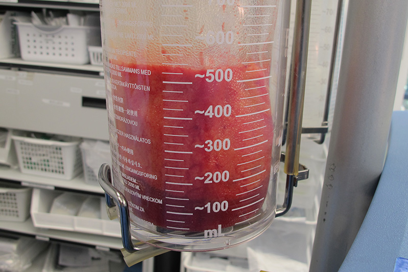 Gynecomastia Surgery Before & After Image