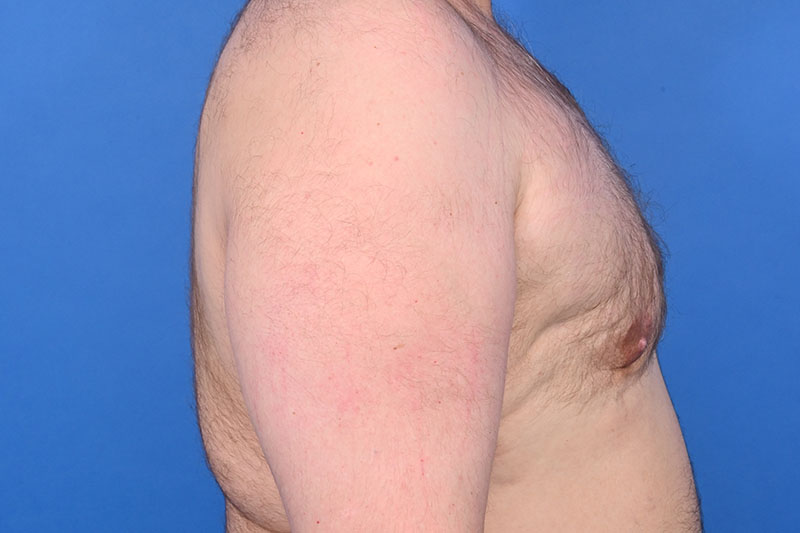 Gynecomastia Surgery Before & After Image