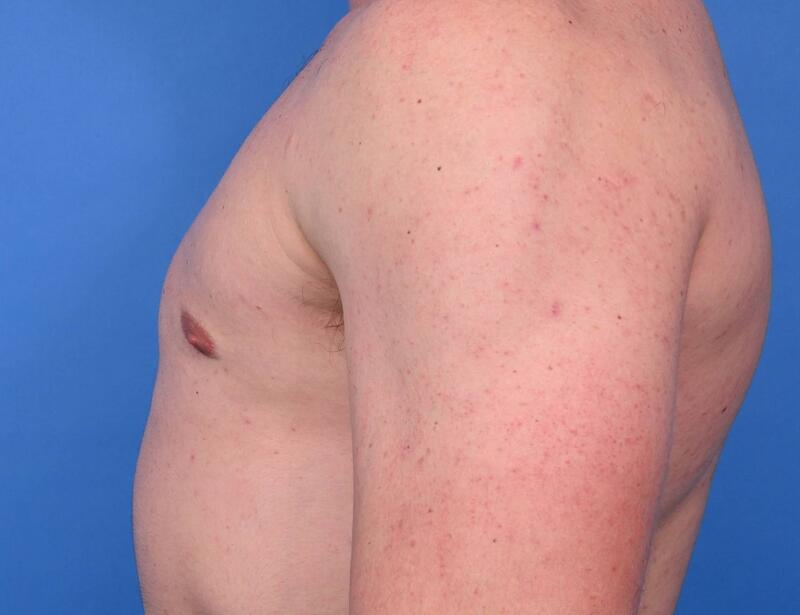 Gynecomastia Surgery Before & After Image