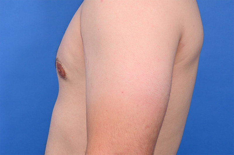 Gynecomastia Surgery Before & After Image