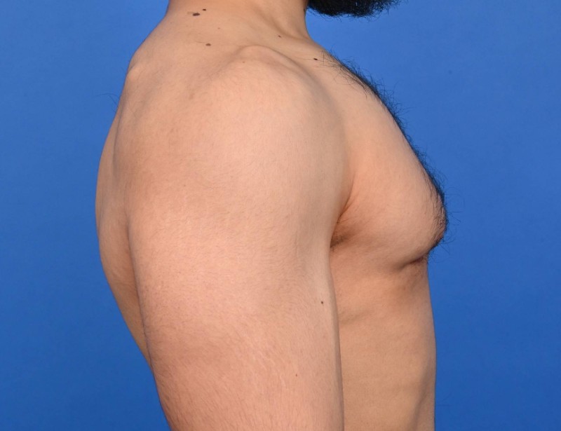 Gynecomastia Surgery Before & After Image
