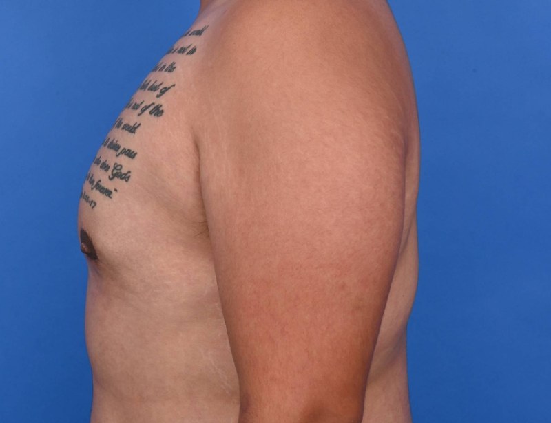 Gynecomastia Surgery Before & After Image
