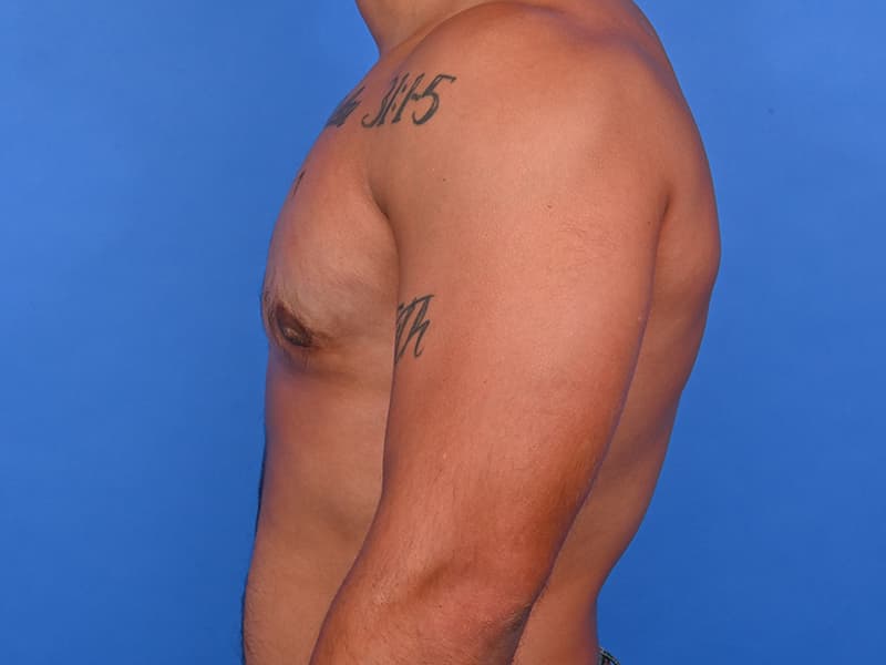 Gynecomastia Surgery Before & After Image