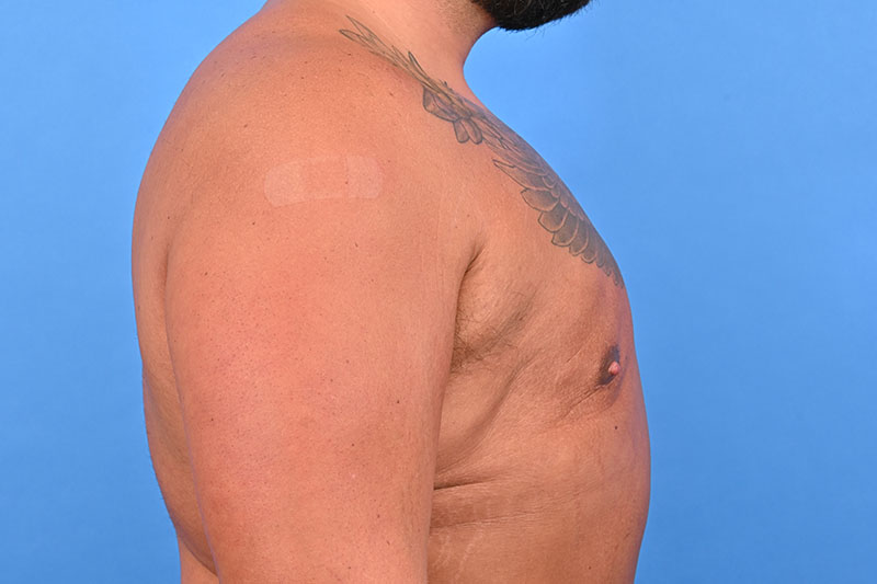 Gynecomastia Surgery Before & After Image