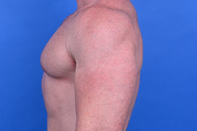 Gynecomastia Surgery Before & After Image