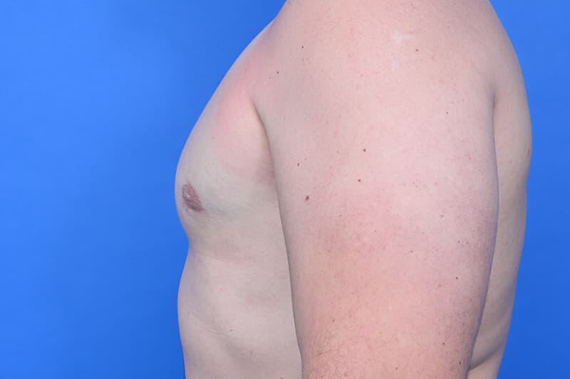 Gynecomastia Surgery Before & After Image
