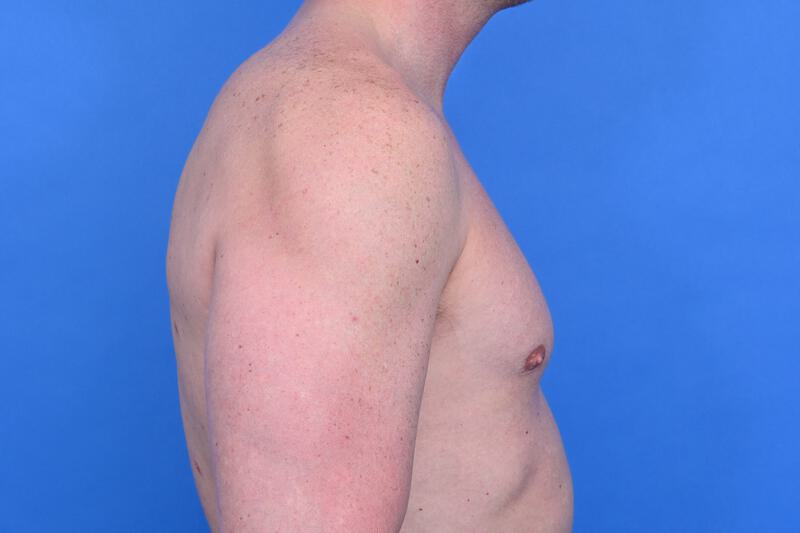 Gynecomastia Surgery Before & After Image