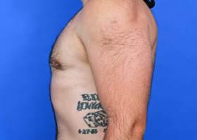 Gynecomastia Surgery Before & After Image