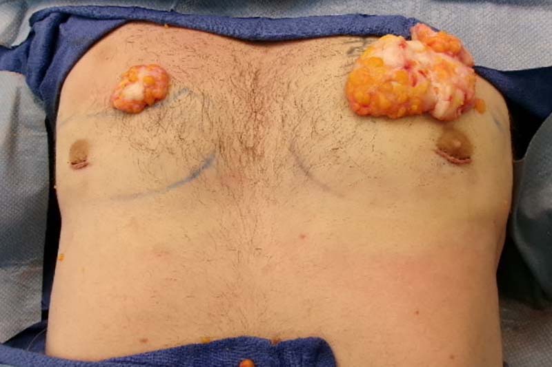 Gynecomastia Surgery Before & After Image