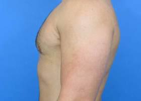 Gynecomastia Surgery Before & After Image