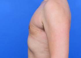 Gynecomastia Surgery Before & After Image