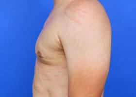 Gynecomastia Surgery Before & After Image