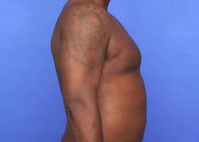 Gynecomastia Surgery Before & After Image