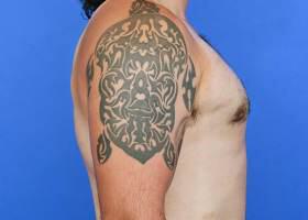 Gynecomastia Surgery Before & After Image