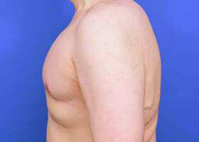 Gynecomastia Surgery Before & After Image