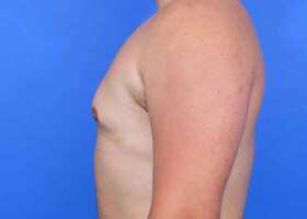 Gynecomastia Surgery Before & After Image