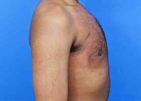 Gynecomastia Surgery Before & After Image