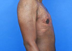 Gynecomastia Surgery Before & After Image