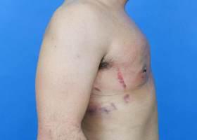 Gynecomastia Surgery Before & After Image