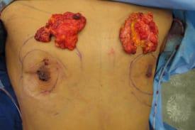 Gynecomastia Surgery Before & After Image