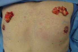 Gynecomastia Surgery Before & After Image
