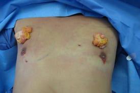 Gynecomastia Surgery Before & After Image